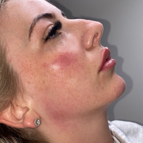CHEEKS, CHIN & JAWLINE Jawline After
