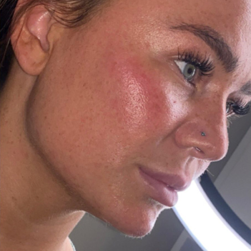 CHEEKS, CHIN & JAWLINE Cheeks After