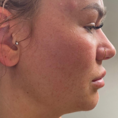 CHEEKS, CHIN & JAWLINE Cheeks Before
