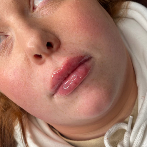 Lip Augmentation Lip augmentation after