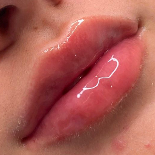 Lip Augmentation Augmentation after