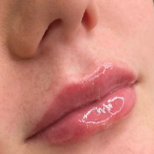 Lip Augmentation After Lip Augmentation