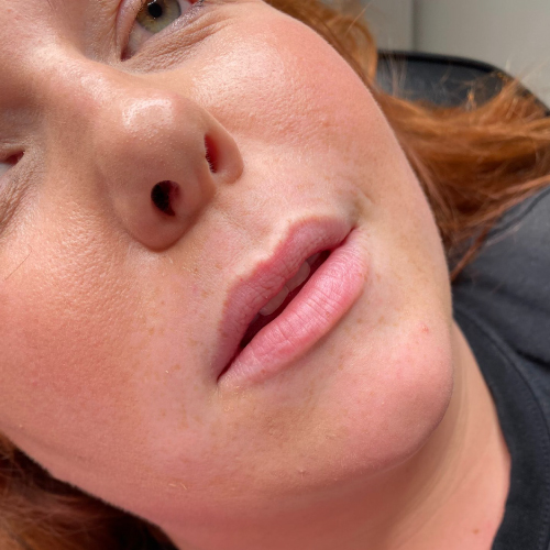 Lip Augmentation Lip augmentation before
