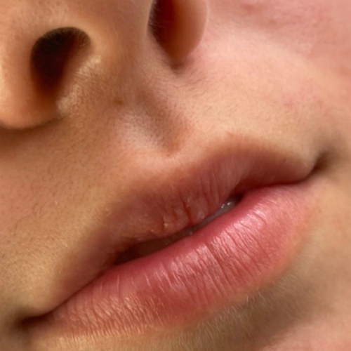 Lip Augmentation Augmentation before