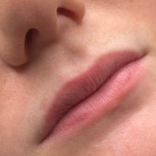 Lip Augmentation Before Lip Augmentation