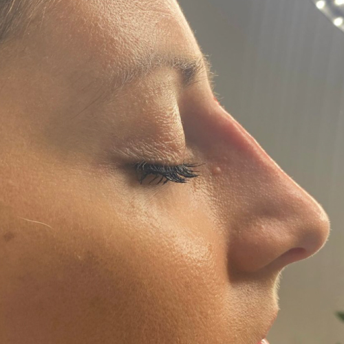 LIQUID RHINOPLASTY Liquid rhinoplasty after