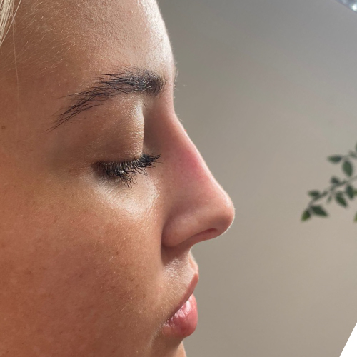 LIQUID RHINOPLASTY After liquid rhinoplasty