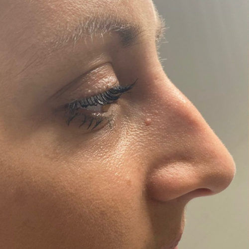LIQUID RHINOPLASTY Liquid rhinoplasty before