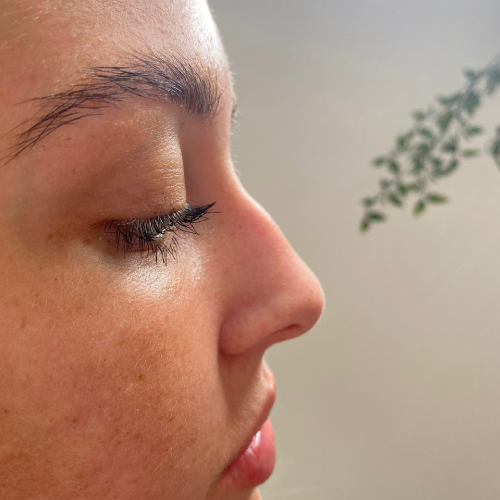 LIQUID RHINOPLASTY Before liquid rhinoplasty