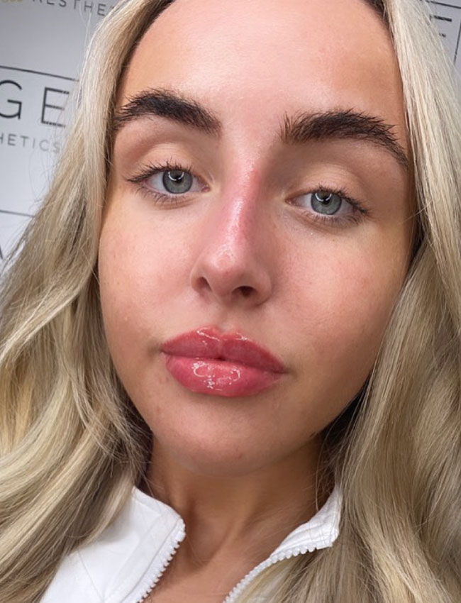 Lip Filler Wigan