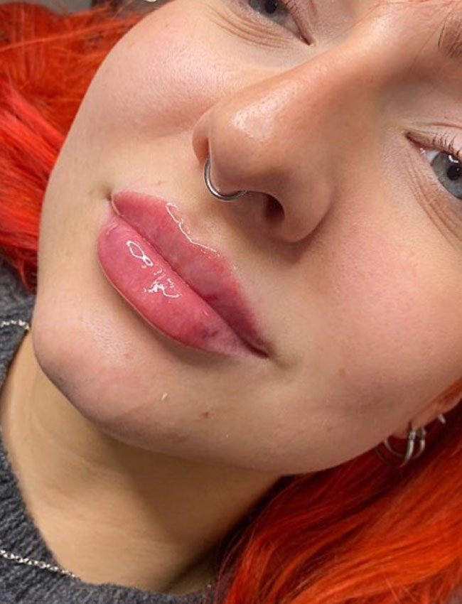 Lip Fillers Wigan