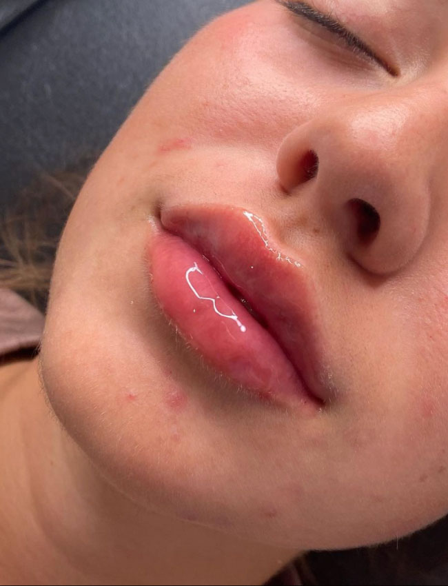 Our Lip Fillers Wigan Clinic