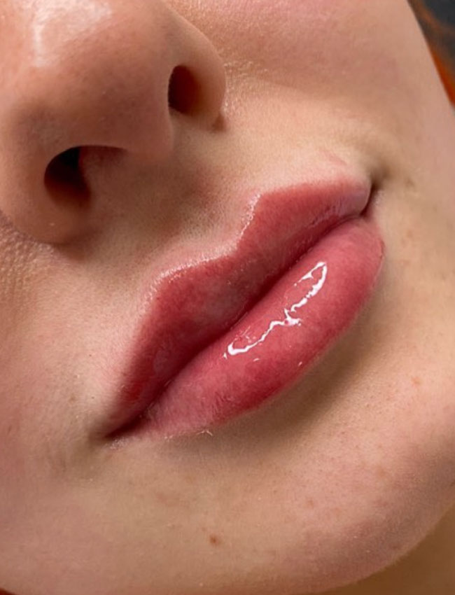 Russian Lip Fillers Wigan